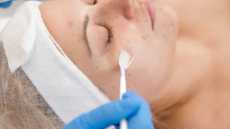 Peeling Rose de Mer: Tudo sobre a técnica!